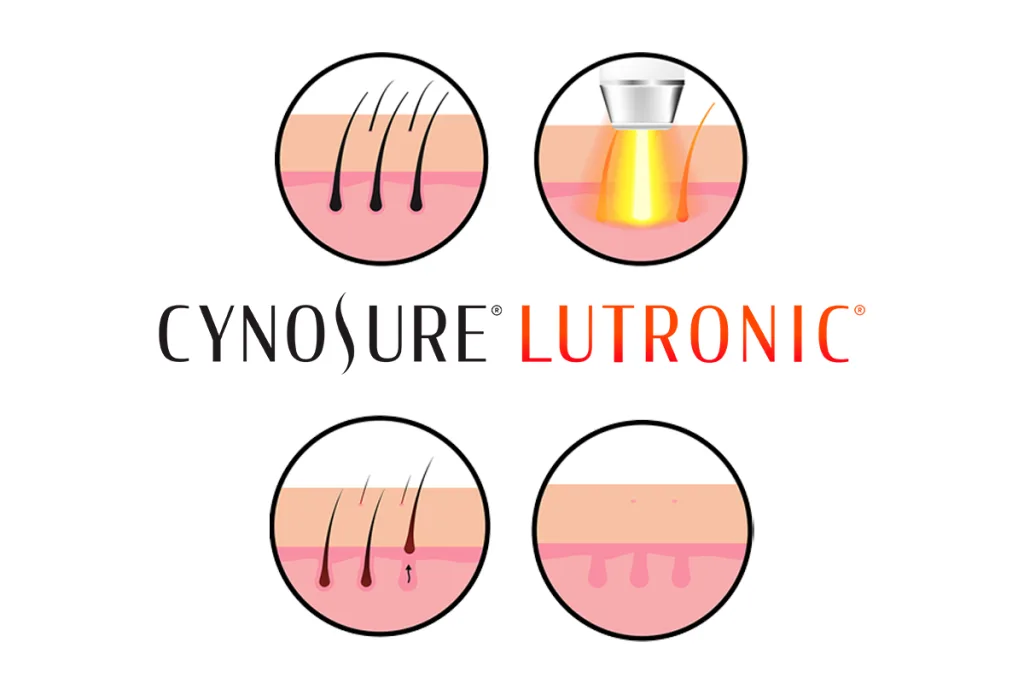 Como funciona a depilação a laser?